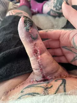 abdominal-phalloplasty-stage-1-uk-update-day-18-v0-ndz80diqf7we1.webp