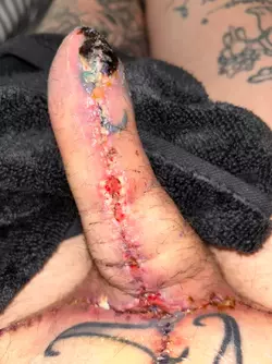 abdominal-phalloplasty-stage-1-uk-update-day-18-v0-xg4swciqf7we1.webp
