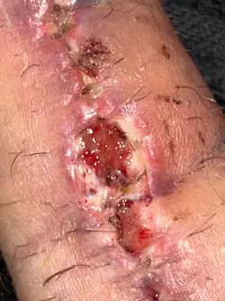 abdominal-phalloplasty-stage-1-uk-update-day-18-v0-nk57zciqf7we1.webp