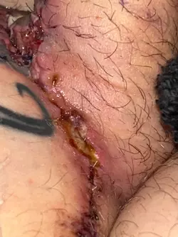 abdominal-phalloplasty-stage-1-uk-update-day-18-v0-8ccgqdiqf7we1.webp