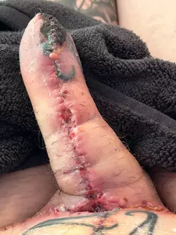 abdominal-phalloplasty-stage-1-uk-update-day-18-v0-0220gdiqf7we1.webp