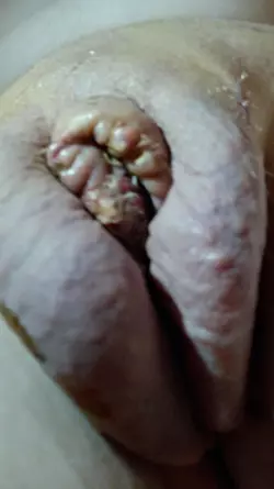 6-days-post-op-vulvoplasty-concerns-v0-n4f01u6prmwe1.webp