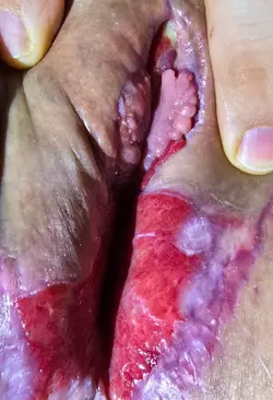 scrotal-graft-vaginoplasty-help-v0-tcsw8okt6hwe1.webp