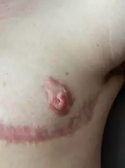 raised-nipple-permanent-swelling-v0-rzt7e9hbghwe1.webp