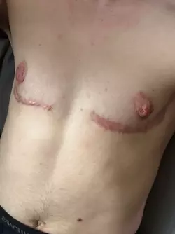 raised-nipple-permanent-swelling-v0-tvq8p5hbghwe1.webp