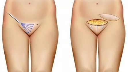 Monsplasty-–-Surgery-for-Bulging-Mons.webp
