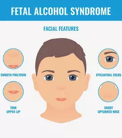 Fetal-Alcohol-Syndrome-Causes-Symptoms-And-Treatment_1200px.jpg.webp