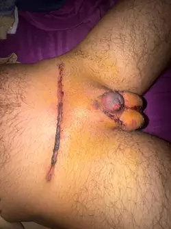 monsplasty-and-stage-2-implants-v0-f4x81xv8r3ye1.webp