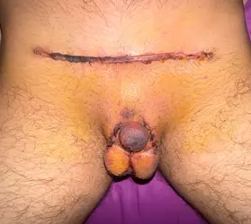 monsplasty-and-stage-2-implants-v0-2vvnkrv8r3ye1.webp