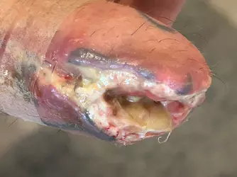 abdominal-phalloplasty-stage-1-uk-update-1-month-post-op-v0-i1arnnbgwjye1.webp