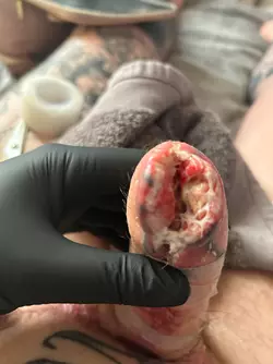 abdominal-phalloplasty-stage-1-uk-update-1-month-post-op-v0-cqfqnsbgwjye1.webp