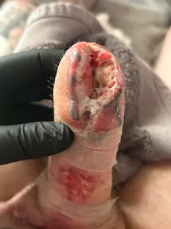 abdominal-phalloplasty-stage-1-uk-update-1-month-post-op-v0-l48irnbgwjye1.webp