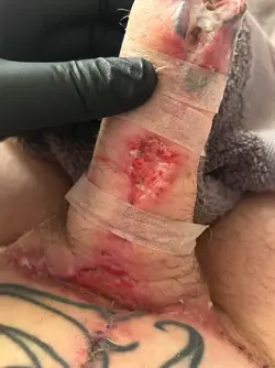 abdominal-phalloplasty-stage-1-uk-update-1-month-post-op-v0-501mhlcgwjye1.webp