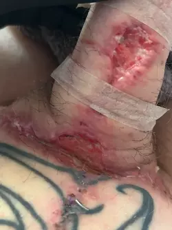 abdominal-phalloplasty-stage-1-uk-update-1-month-post-op-v0-p74ownbgwjye1.webp