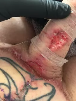 abdominal-phalloplasty-stage-1-uk-update-1-month-post-op-v0-zlcmbpbgwjye1.webp