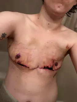 am-i-the-only-one-that-looks-like-this-post-op-v0-4liqyiex5iye1.webp