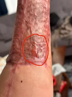 ive-already-contacted-my-microsurgeon-has-anyone-had-this-v0-h049ecglomze1.webp