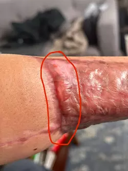 ive-already-contacted-my-microsurgeon-has-anyone-had-this-v0-dgql1whlomze1.webp