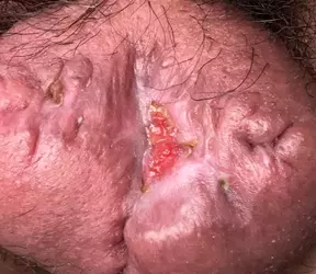 necrosis-on-scrotum-update-v0-cf6j5qe5okze1.webp