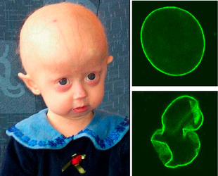 Hutchinson-Gilford_Progeria_Syndrome.webp