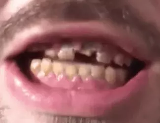 42024 teeth.webp