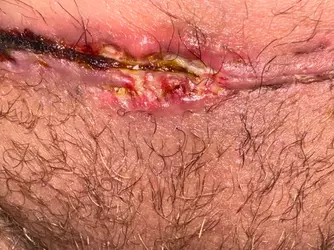 worried-about-incision-gory-photo-v0-6fecvxskcw0f1.webp
