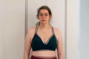 2-months-post-op-clavicle-reduction-with-dr-leif-rogers-v0-h7doi2gs4e0f1.webp