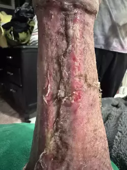 arm-graft-concerns-v0-cw5n6kxd000f1.webp
