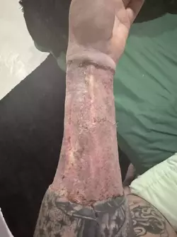 arm-graft-concerns-v0-2kf4oexd000f1.webp
