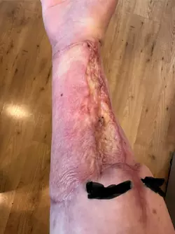 rff-arm-graft-5-months-post-op-keloid-questions-v0-whfkupd2js1f1.webp