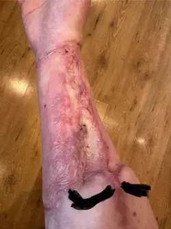rff-arm-graft-5-months-post-op-keloid-questions-v0-pjr2i5e2js1f1.webp