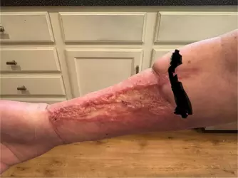 rff-arm-graft-5-months-post-op-keloid-questions-v0-dnabypd2js1f1.webp
