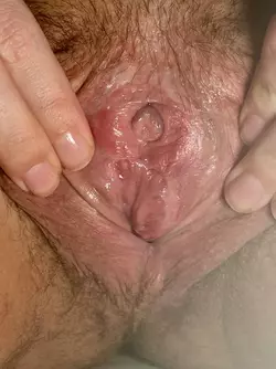 one-inner-labia-being-pushed-back-by-vestibule-tissue-6-v0-m8lr9qz0ul1f1.webp