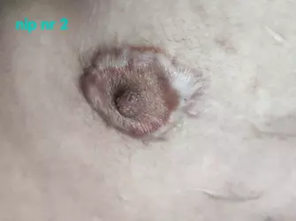 scarring-making-nipple-areola-size-huge-v0-61o4hjpmgd1f1.webp