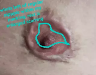 scarring-making-nipple-areola-size-huge-v0-xd94islmgd1f1.webp