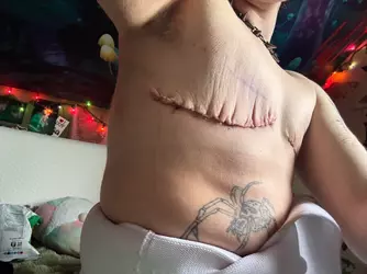 top-surgery-day-11-post-op-v0-0326o1yden1f1.webp