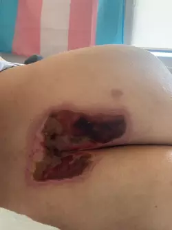 srs-in-poland-gyneka-cracow-7-weeks-post-op-d-v0-oldzvgdeye2f1.webp
