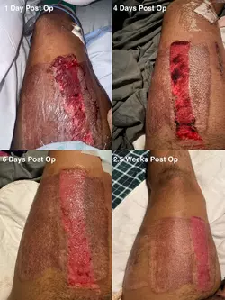 1-day-2-5-weeks-post-op-stage-2-rff-w-nyu-rachel-bluebond-v0-chs5s2d8ee3f1.webp