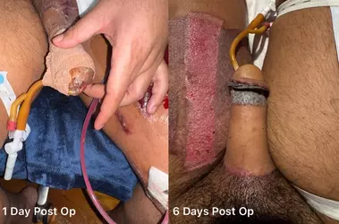 1-day-2-5-weeks-post-op-stage-2-rff-w-nyu-rachel-bluebond-v0-4a8dfys6ee3f1.webp