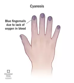 24297-cyanosis.webp