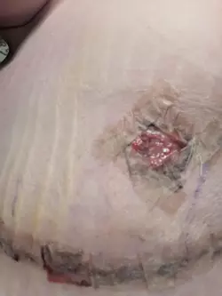 top-surgery-9-days-post-op-anxious-v0-9brcpd370d4f1.webp