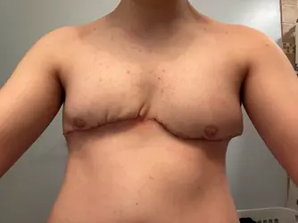 incredibly-upset-with-my-chest-post-op-v0-wjcyrl9v424f1.webp