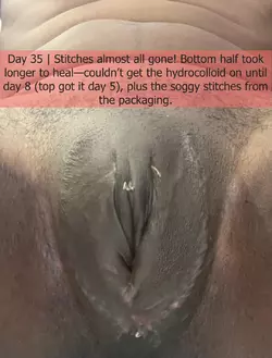 part-2-dr-kenan-celtik-crane-center-sf-post-op-photo-dump-v0-h129i5ersy3f1.webp