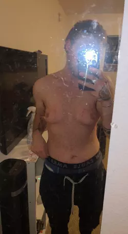 3-years-1-year-1-day-pre-op-v0-36y65mntui4f1.webp