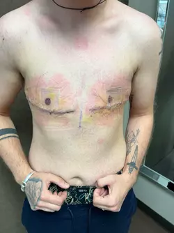 3-years-1-year-1-day-pre-op-v0-k59rolntui4f1.webp