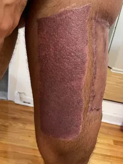 a-little-over-2-months-post-op-alt-from-nyu-v0-rw1sdvy8kf4f1.webp