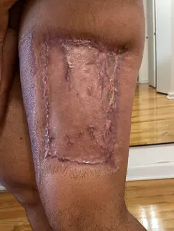 a-little-over-2-months-post-op-alt-from-nyu-v0-fzealty8kf4f1.webp