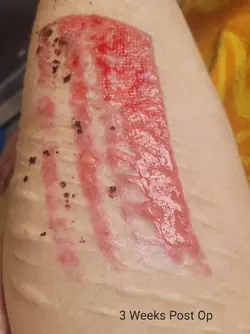 3-weeks-post-op-stage-1-alt-phallo-with-dr-mijuscovic-in-v0-qc8f103g945f1.webp