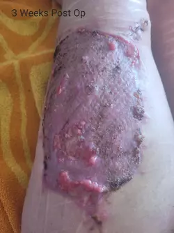 3-weeks-post-op-stage-1-alt-phallo-with-dr-mijuscovic-in-v0-d7t9fekf945f1.webp