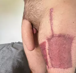 9-weeks-post-op-w-dr-assi-v0-vq6jg71ps45f1.webp